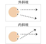 外斜視・内斜視