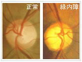 緑内障の症状